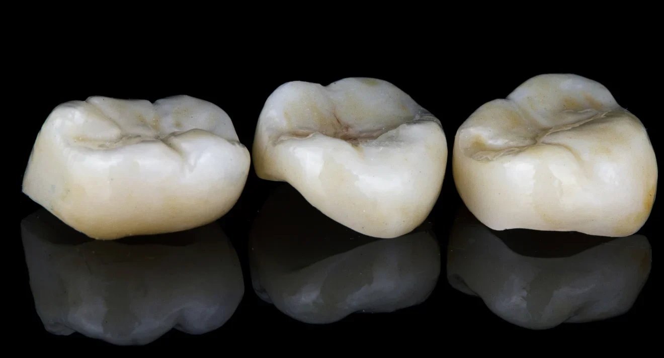 Crowns and Onlays